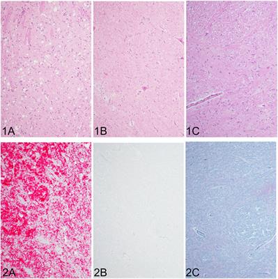 Real-Time Quaking-Induced Conversion Detection of Bovine Spongiform Encephalopathy Prions in a Subclinical Steer